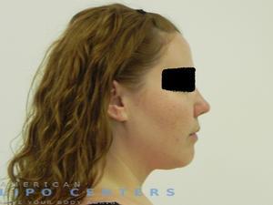 americanlipocenters_102.jpg
